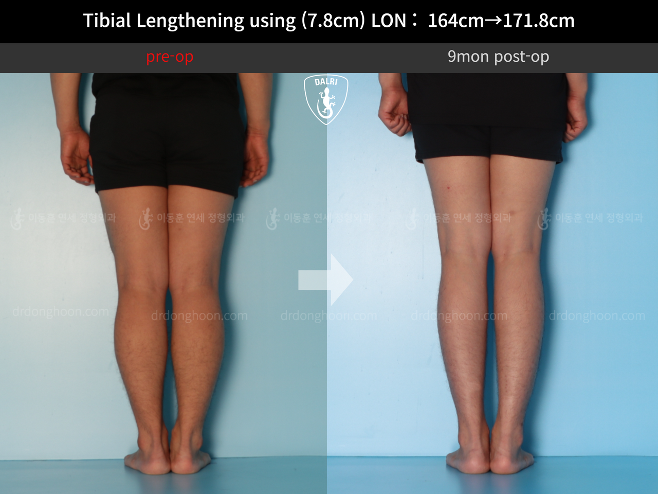 Before and after cll lon, case 12652002, image 6, Dr. Donghoon institute (DALRI)