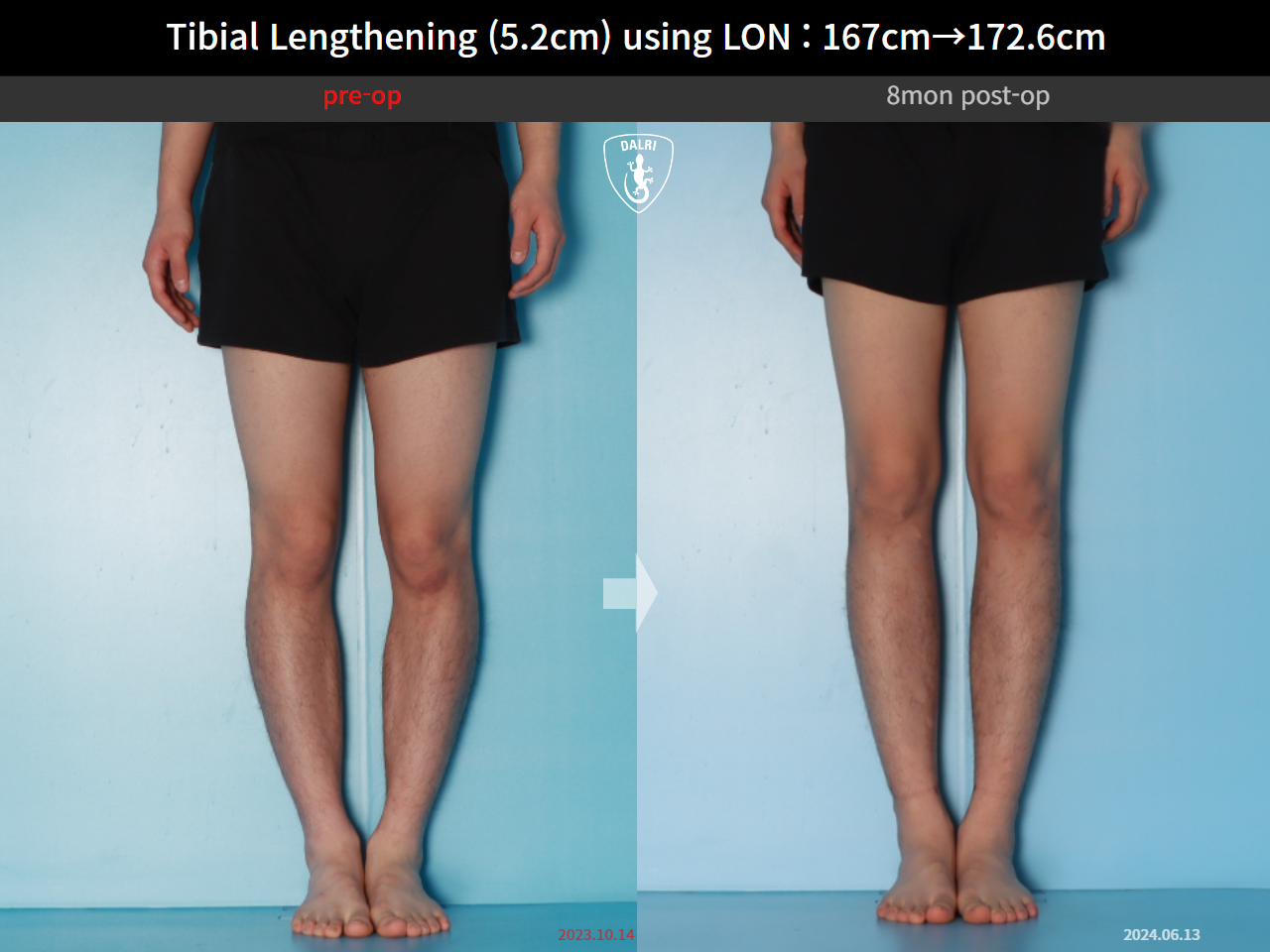 Before and after cll lon, case 29672720, image 7, Dr. Donghoon institute (DALRI)