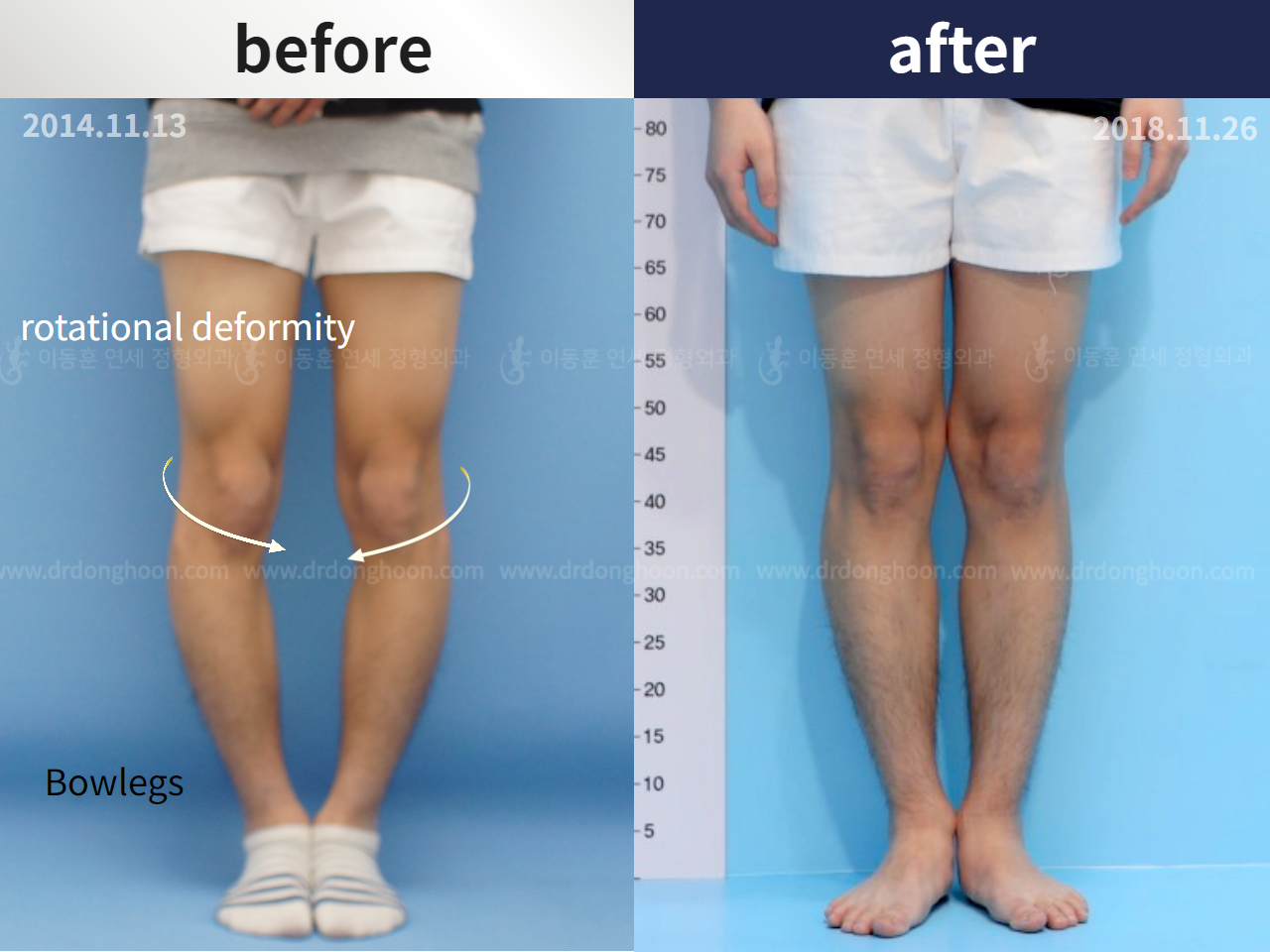 Before and after complex deformity, case 4297333, image 1, Dr. Donghoon institute (DALRI)