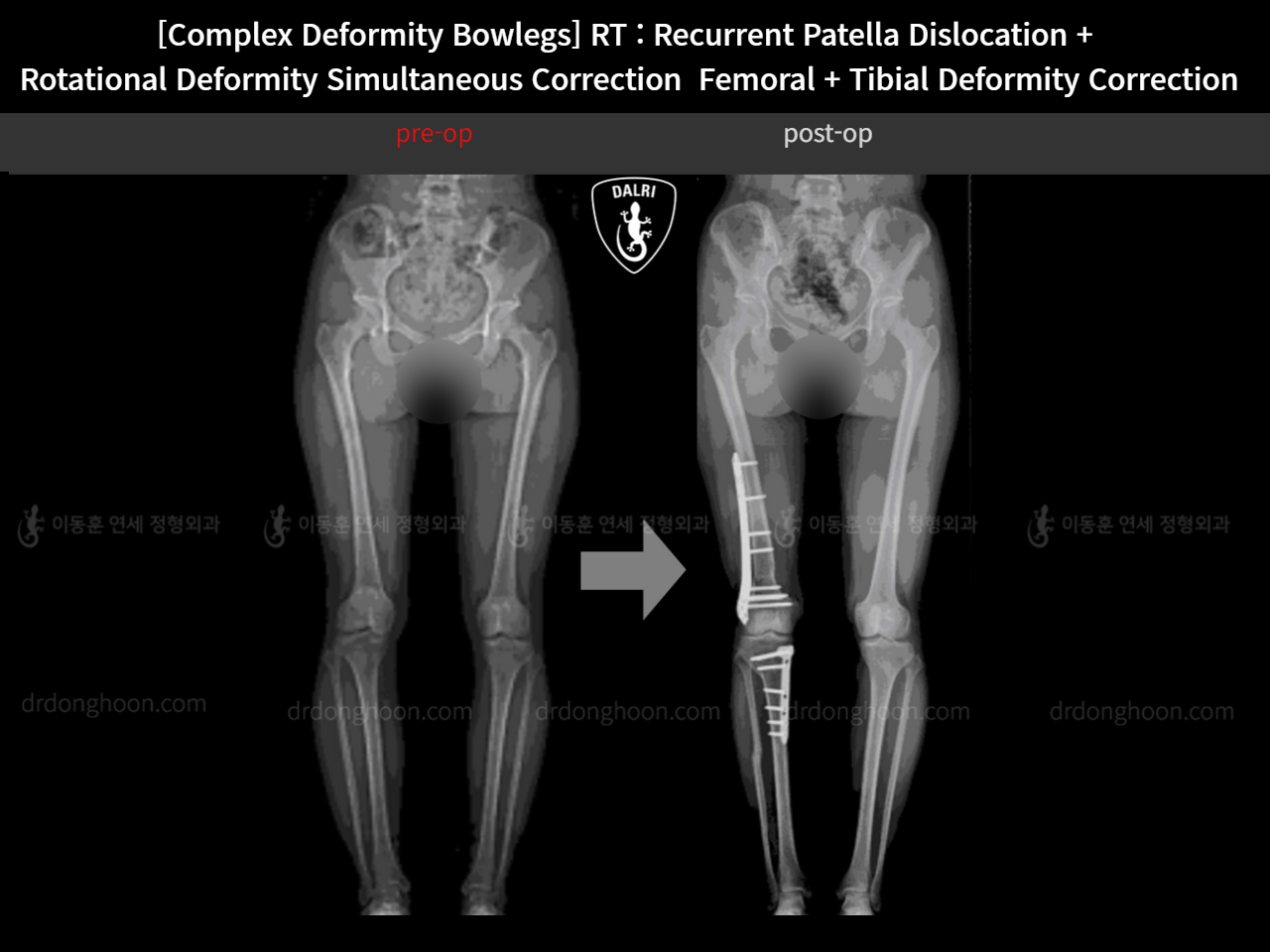 Before and after adult bowlegs, case 14960899, image 11, Dr. Donghoon institute (DALRI)