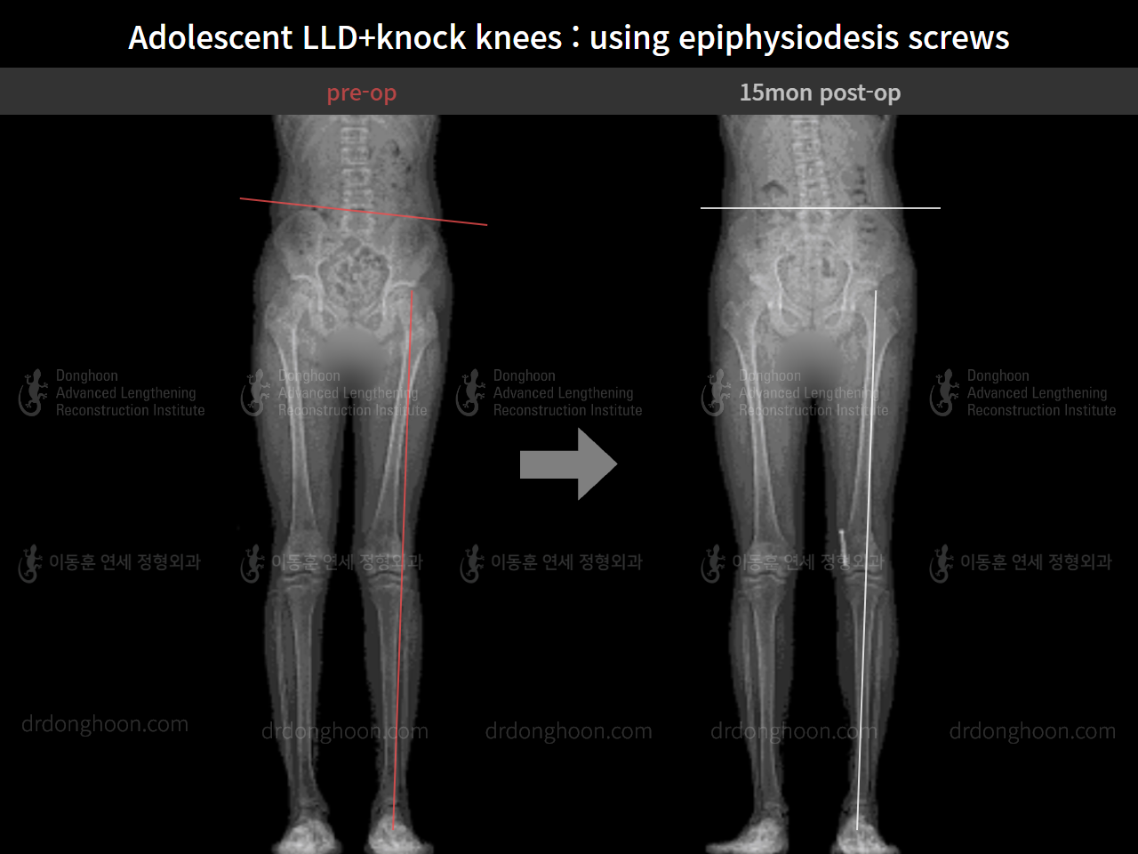 Before and after paediatric & adolescent knock knees, case 8413324, image 5, Dr. Donghoon institute (DALRI)