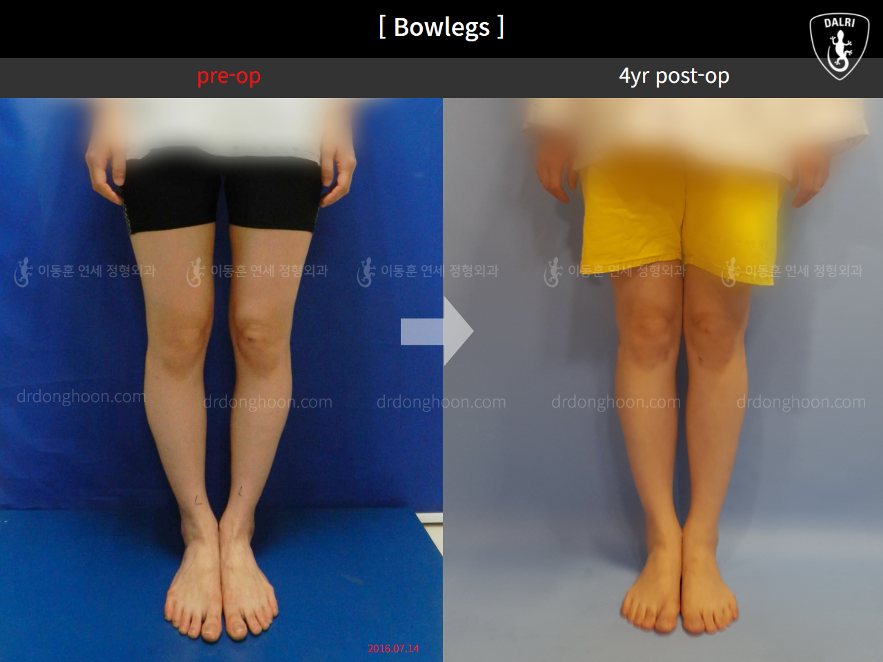 Before and after adult bowlegs, case 4310976, image 4, Dr. Donghoon institute (DALRI)