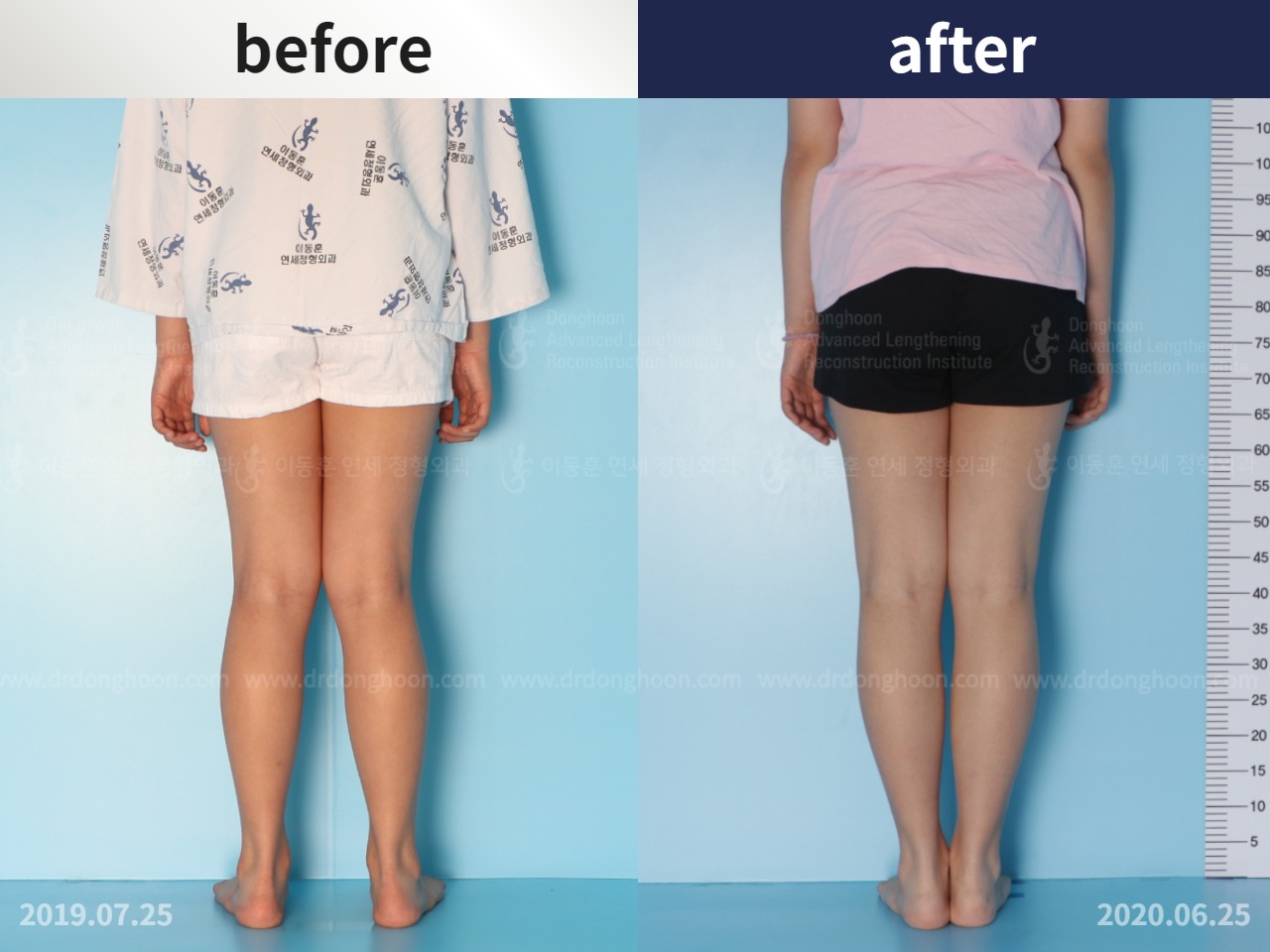 Before and after paediatric & adolescent knock knees, case 4640482, image 2, Dr. Donghoon institute (DALRI)