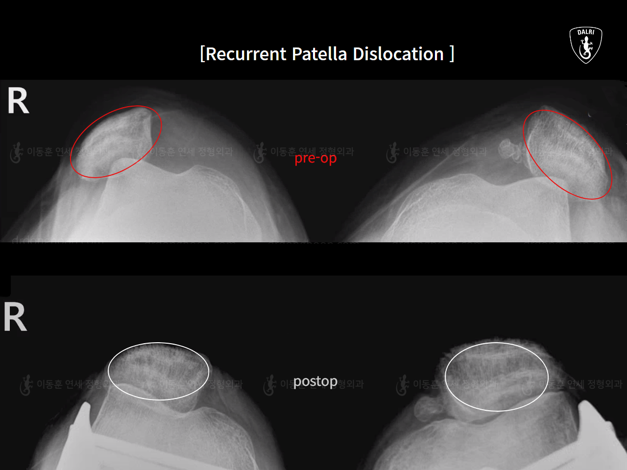 Before and after recurrent patella dislocation, case 17434915, image 9, Dr. Donghoon institute (DALRI)