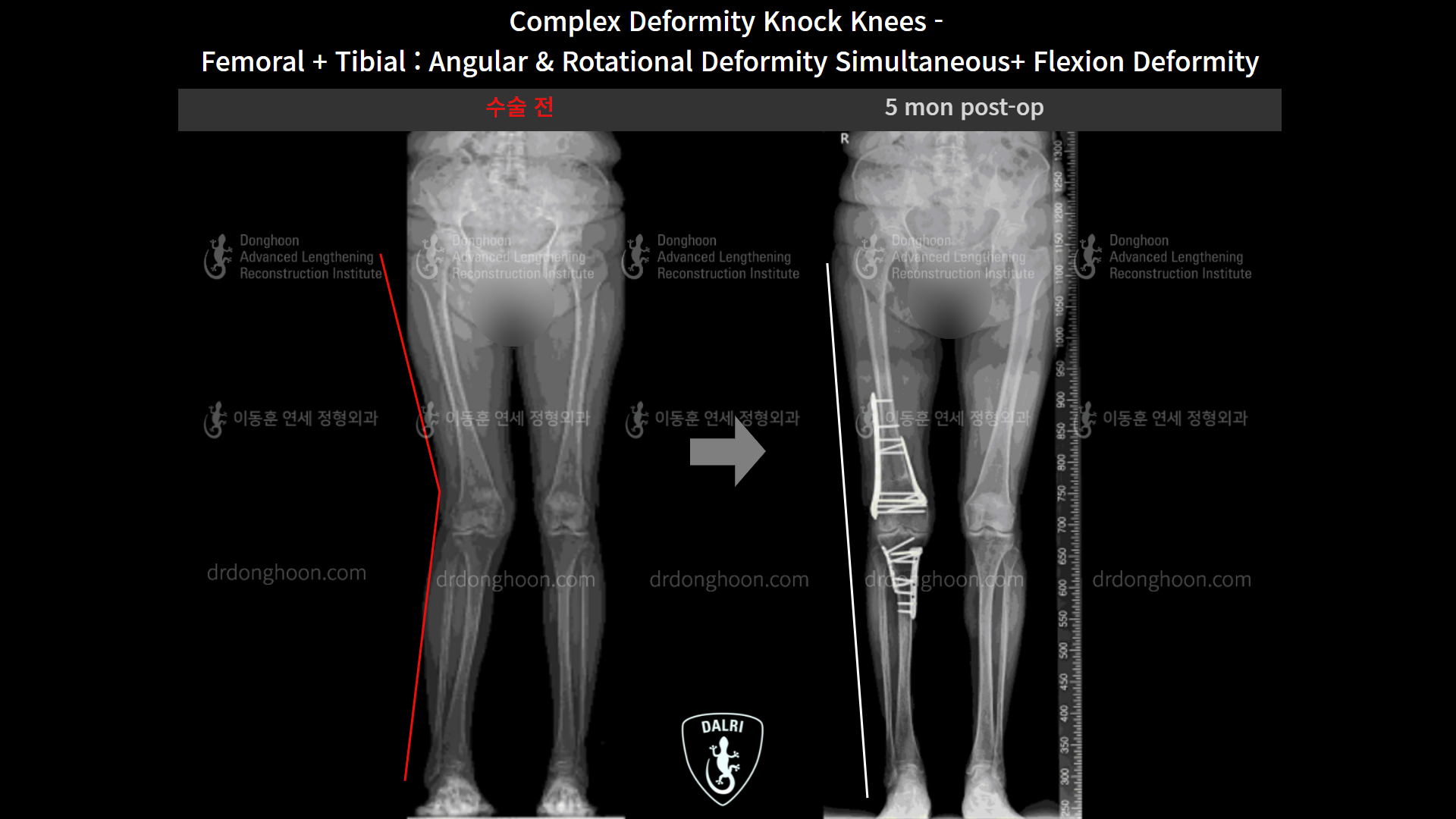Before and after adult knock knees, case 9153798, image 7, Dr. Donghoon institute (DALRI)