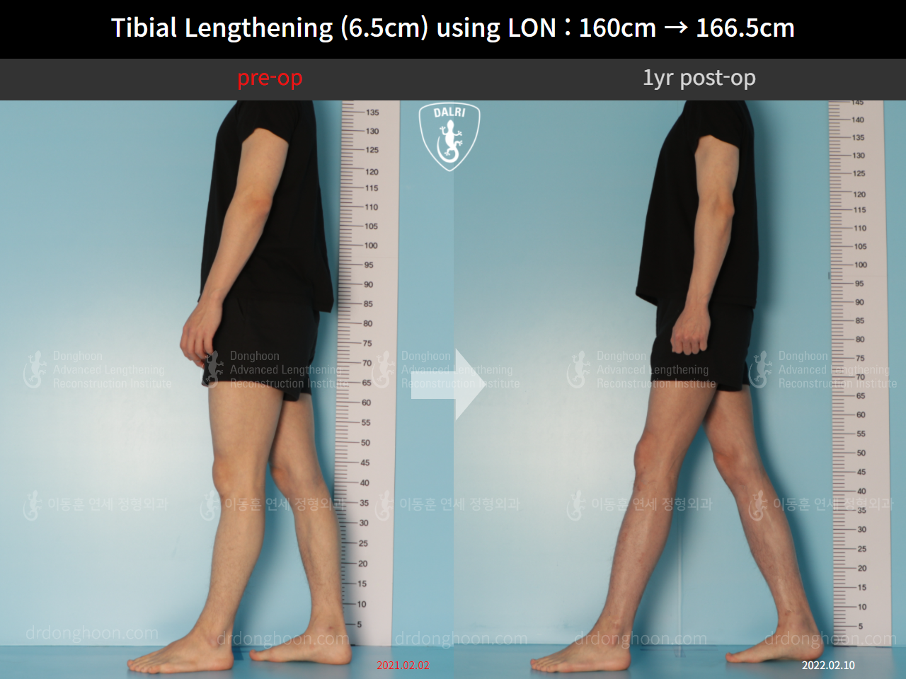 Before and after cll lon, case 10293105, image 3, Dr. Donghoon institute (DALRI)