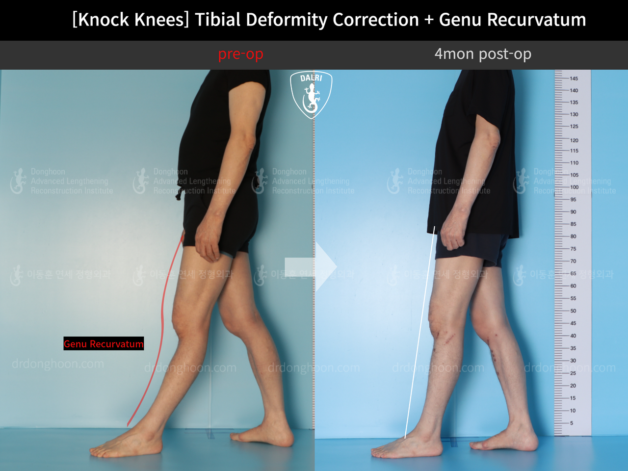 Before and after adult knock knees, case 12846255, image 3, Dr. Donghoon institute (DALRI)