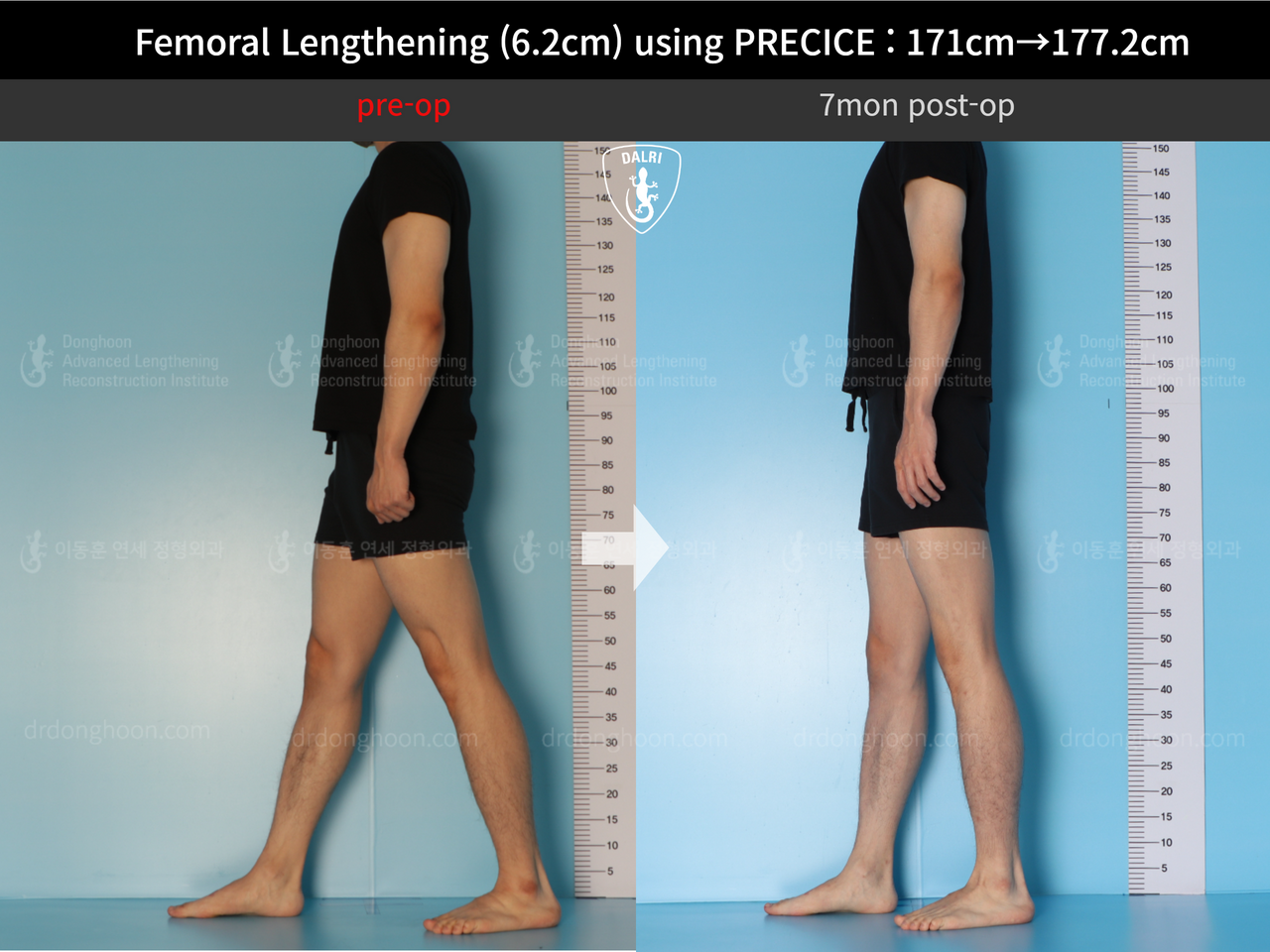 Before and after cll precice, case 13325833, image 8, Dr. Donghoon institute (DALRI)