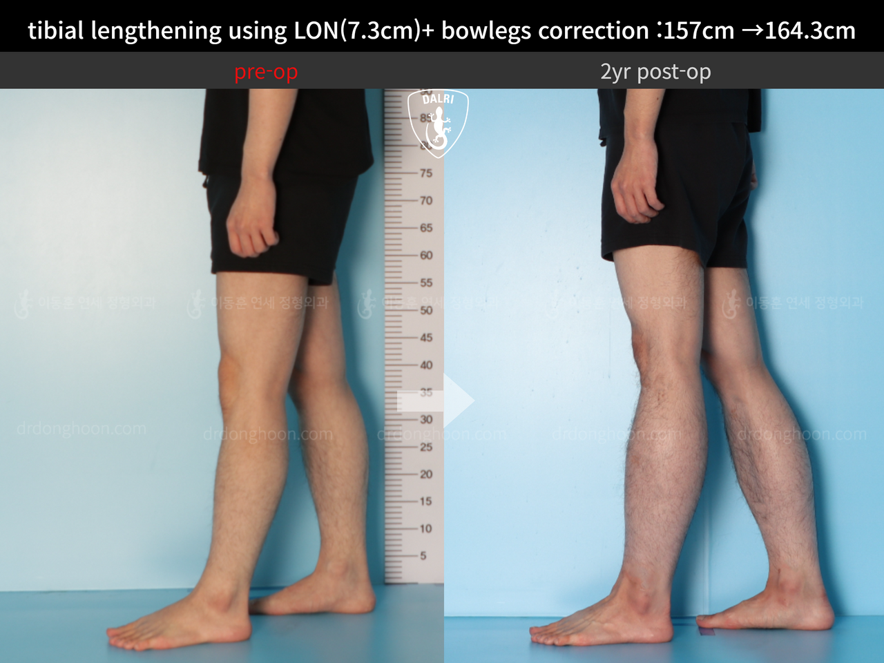 Before and after cll + deformity correction, case 13549500, image 8, Dr. Donghoon institute (DALRI)