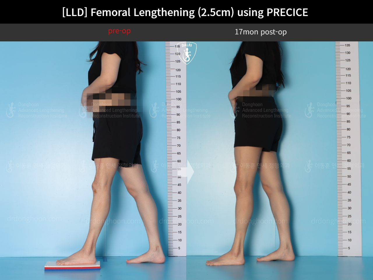 Before and after adult lld, case 18263358, image 3, Dr. Donghoon institute (DALRI)