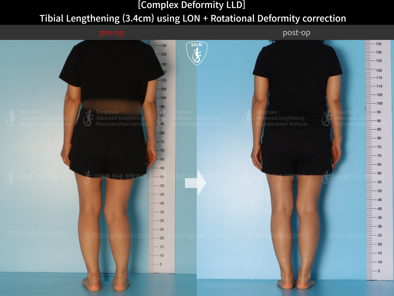 Before and after adult lld, case 14350311, image 3, Dr. Donghoon institute (DALRI)