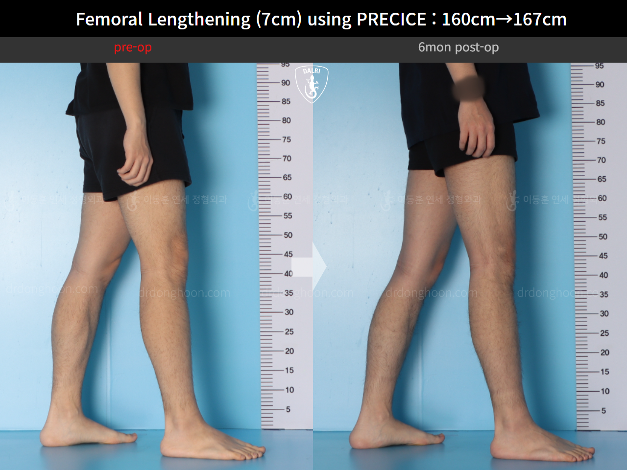 Before and after cll precice, case 15460533, image 12, Dr. Donghoon institute (DALRI)