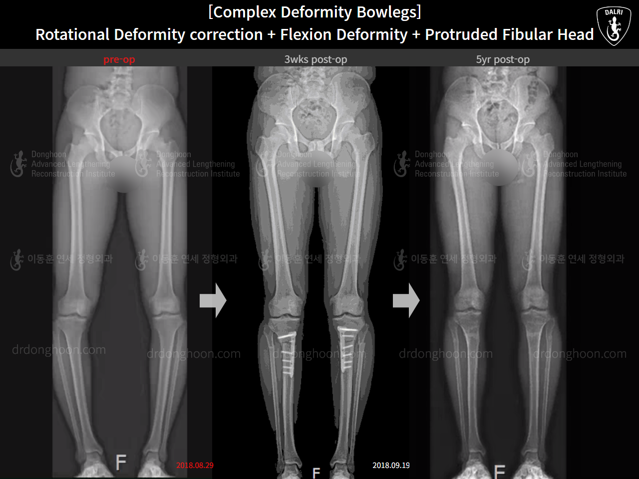 Before and after complex deformity, case 15944755, image 11, Dr. Donghoon institute (DALRI)