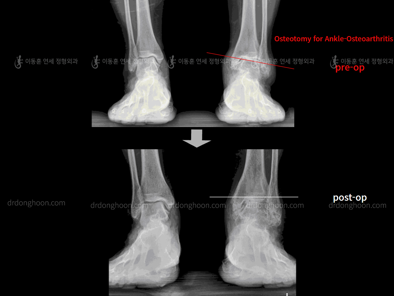 Before and after osteotomy for knee osteoarthritis, case 9057685, image 3, Dr. Donghoon institute (DALRI)