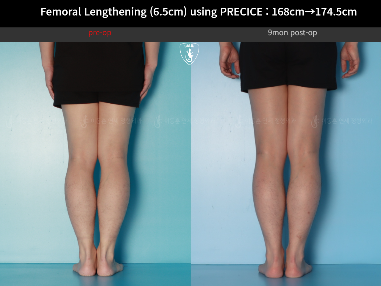 Before and after cll precice, case 123911358, image 8, Dr. Donghoon institute (DALRI)