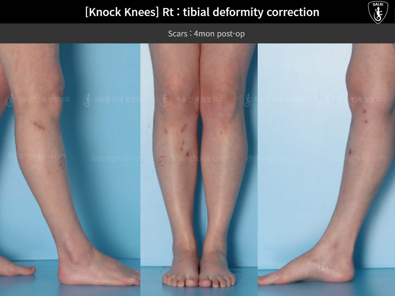 Before and after adult knock knees, case 18411627, image 8, Dr. Donghoon institute (DALRI)