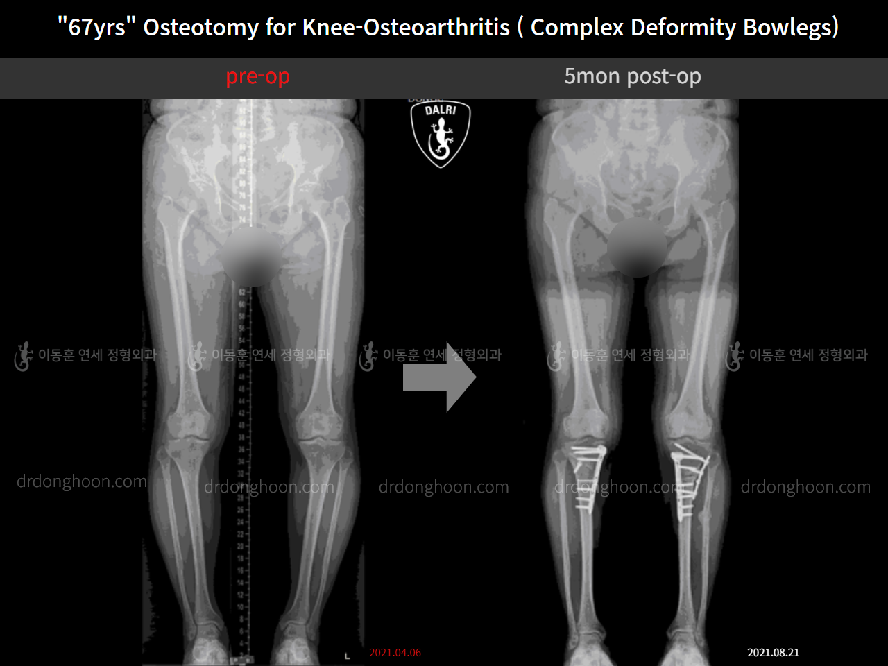 Before and after osteotomy for knee osteoarthritis, case 11339432, image 8, Dr. Donghoon institute (DALRI)