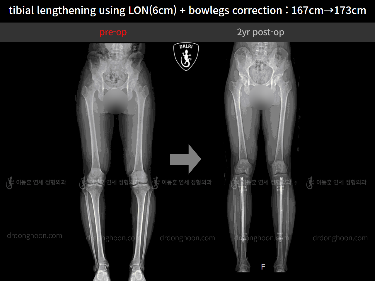 Before and after cll + deformity correction, case 4323147, image 4, Dr. Donghoon institute (DALRI)
