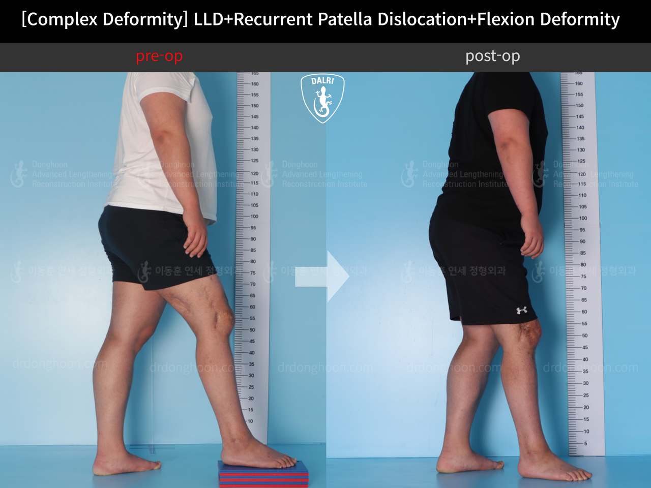 Before and after adult lld, case 12452703, image 3, Dr. Donghoon institute (DALRI)