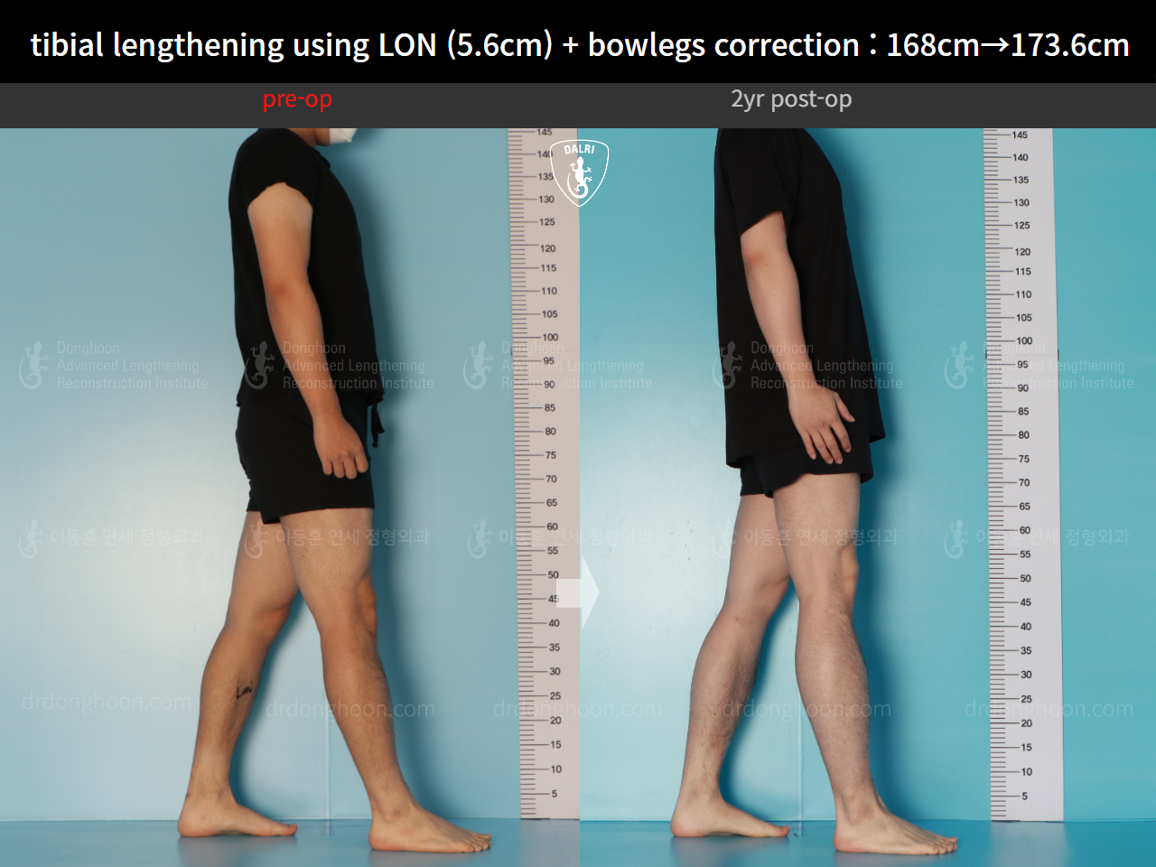 Before and after cll + deformity correction, case 17361975, image 3, Dr. Donghoon institute (DALRI)