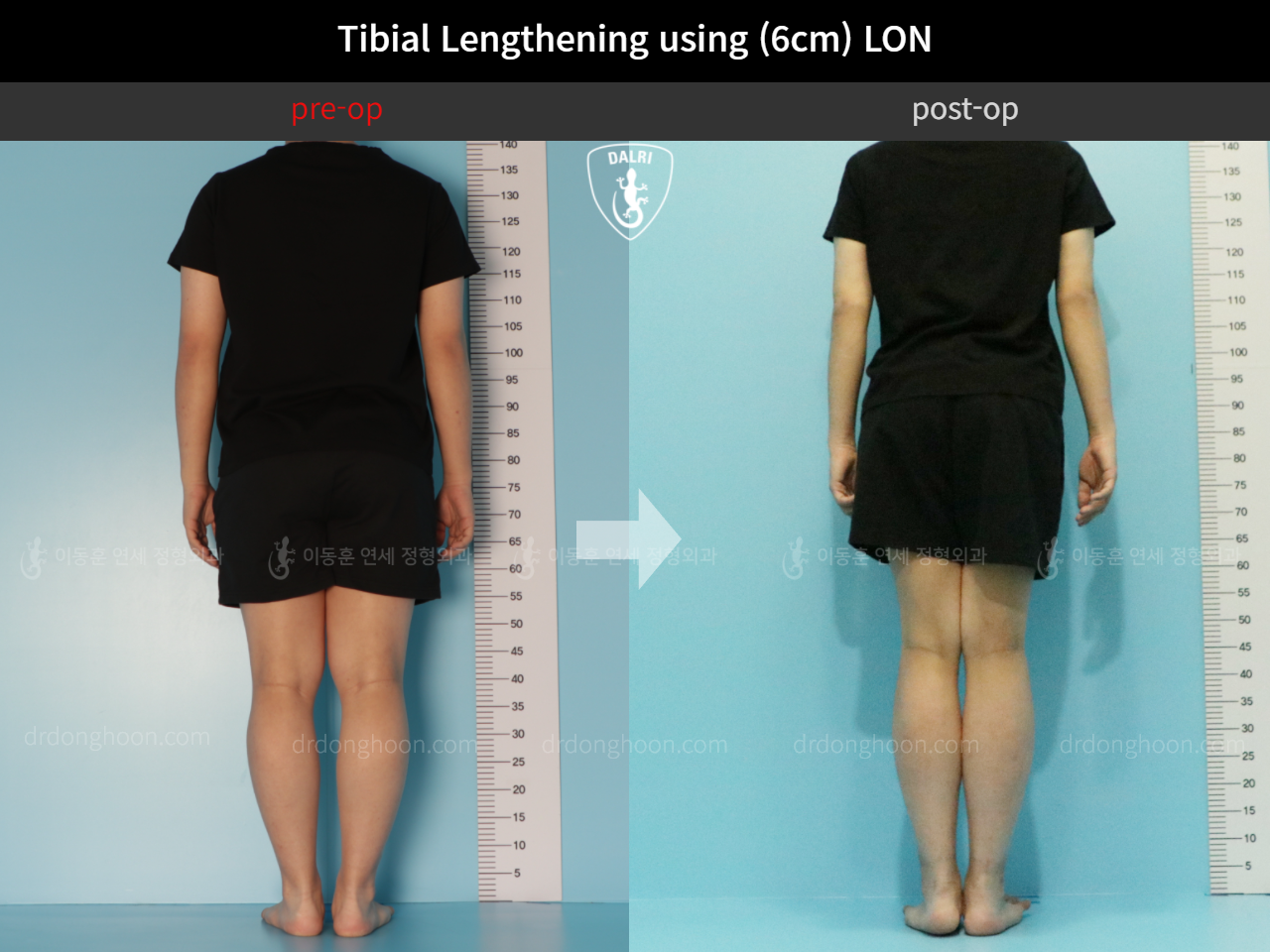 Before and after cll lon, case 11511553, image 2, Dr. Donghoon institute (DALRI)