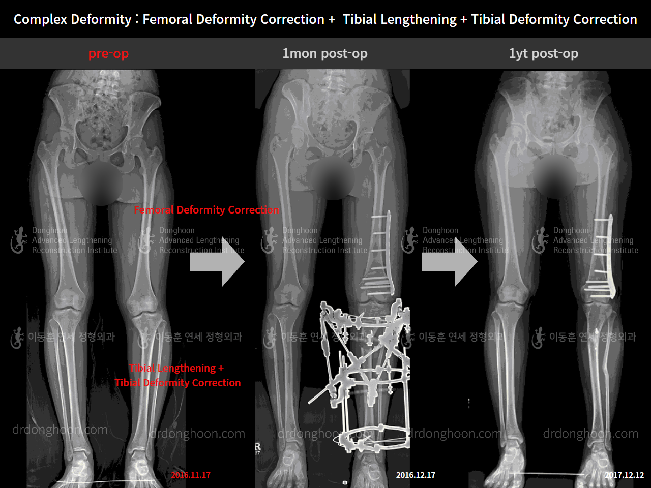 Before and after adult lld, case 4320351, image 1, Dr. Donghoon institute (DALRI)