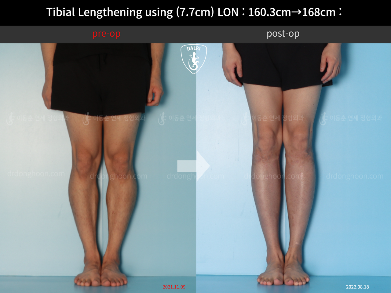Before and after cll lon, case 12643440, image 5, Dr. Donghoon institute (DALRI)