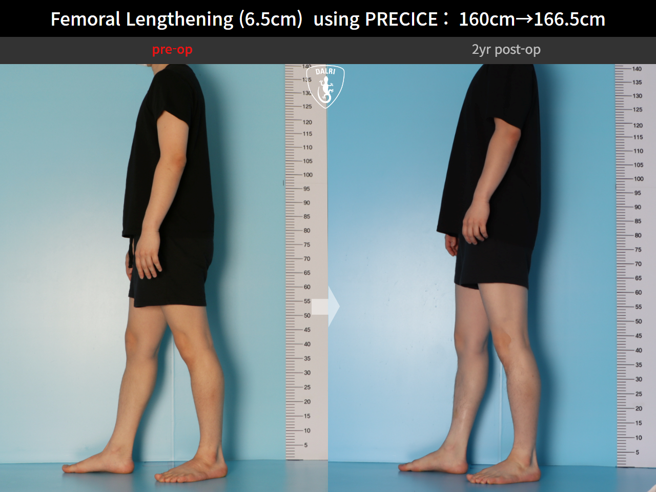 Before and after cll precice, case 27369651, image 4, Dr. Donghoon institute (DALRI)
