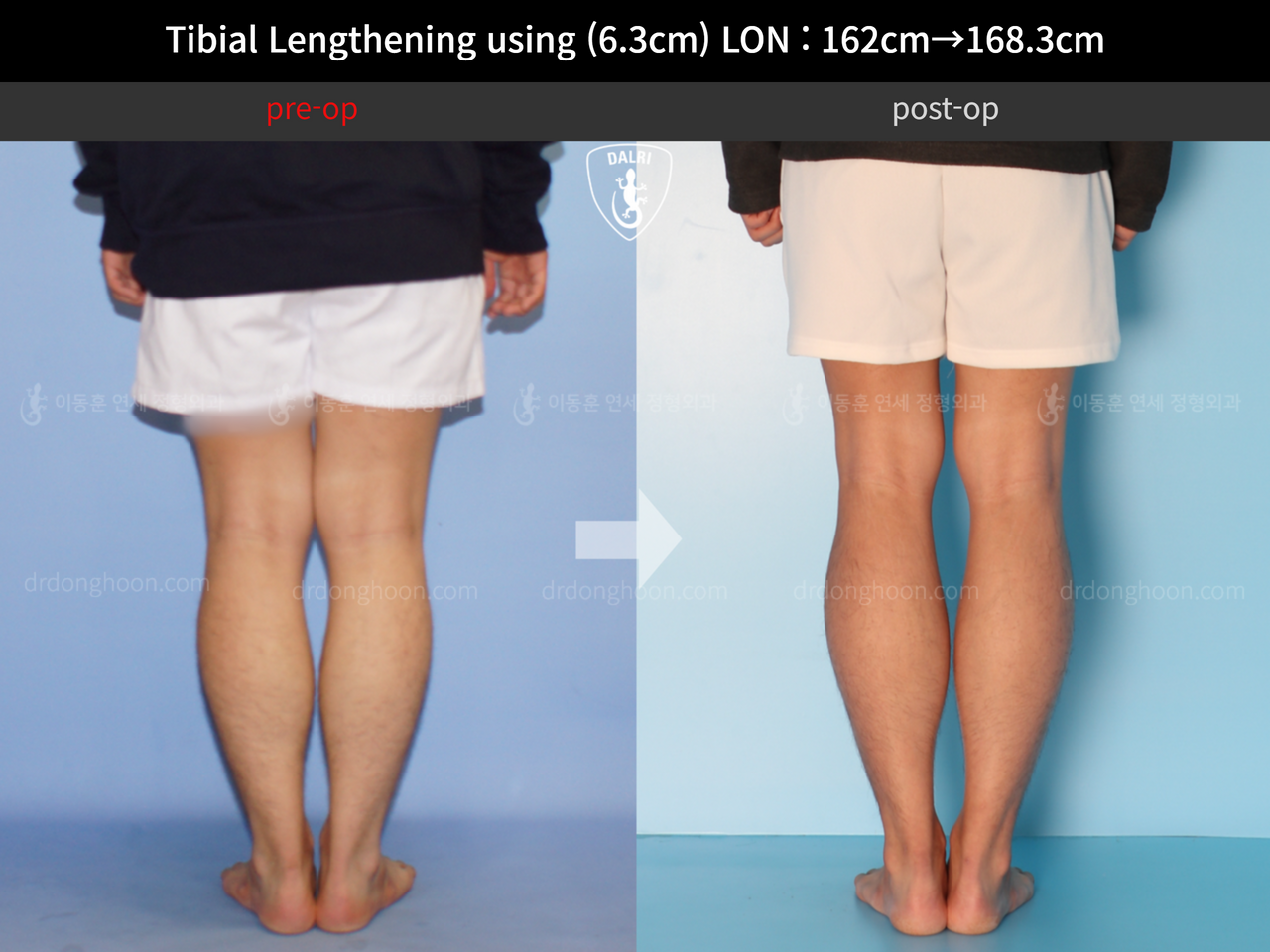 Before and after cll lon, case 12817675, image 5, Dr. Donghoon institute (DALRI)