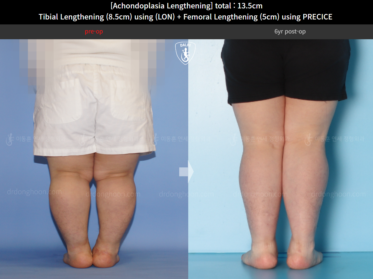 Before and after cll lon, case 14993527, image 10, Dr. Donghoon institute (DALRI)