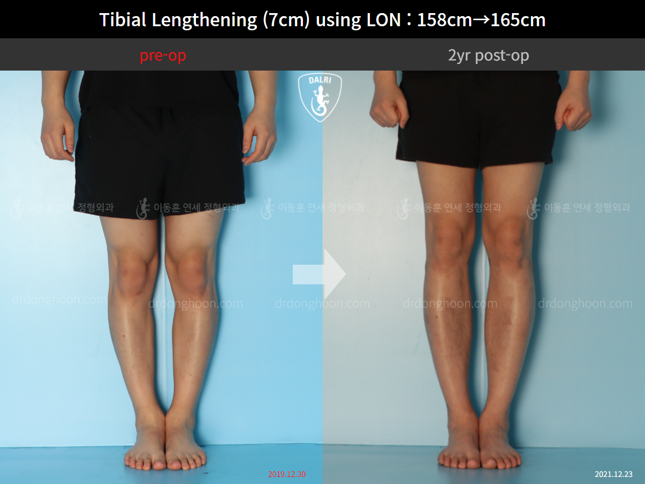Before and after cll lon, case 9325768, image 5, Dr. Donghoon institute (DALRI)