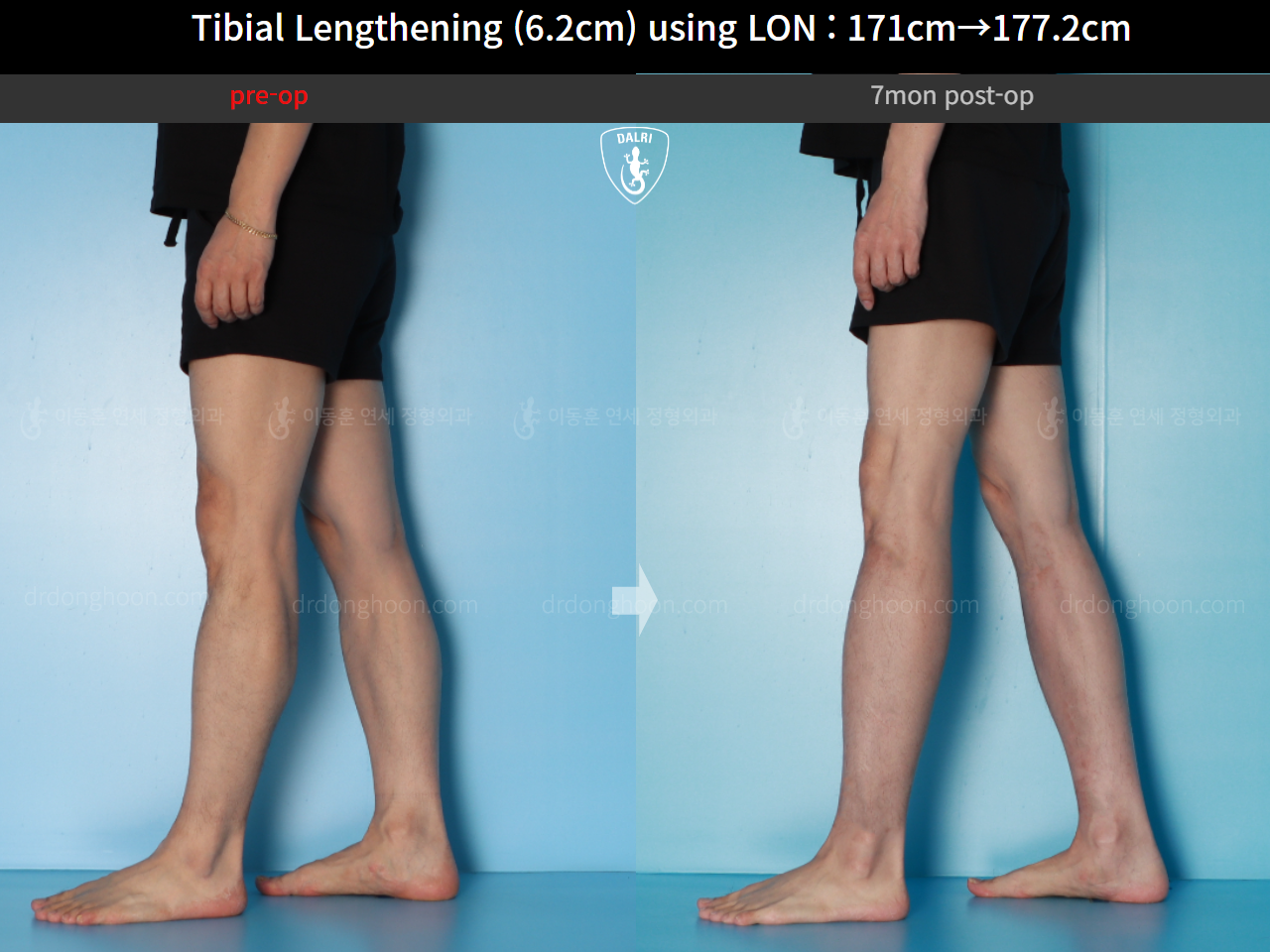 Before and after cll lon, case 16713373, image 10, Dr. Donghoon institute (DALRI)