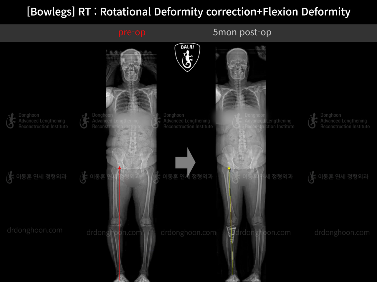 Before and after adult bowlegs, case 13668670, image 8, Dr. Donghoon institute (DALRI)