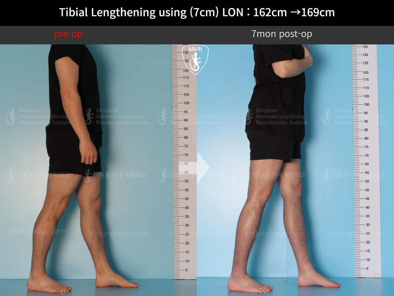 Before and after cll lon, case 13743472, image 6, Dr. Donghoon institute (DALRI)