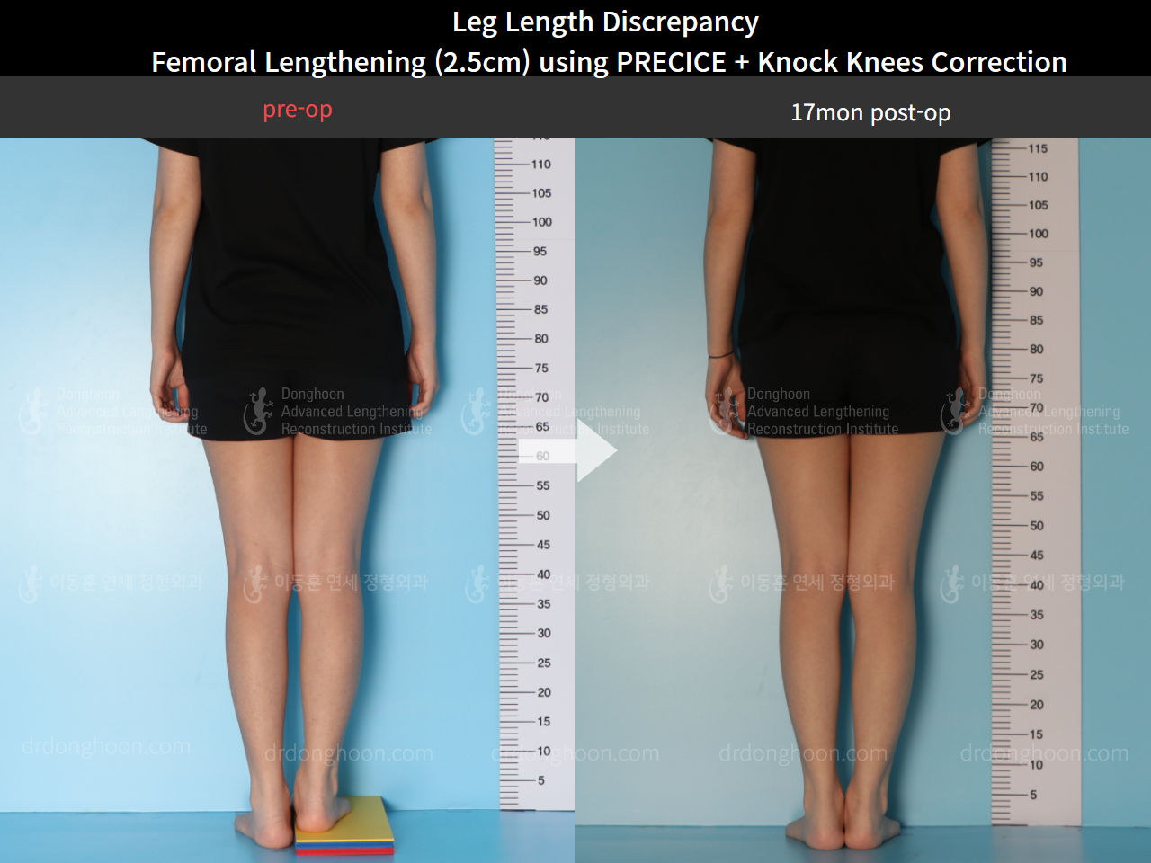 Before and after adult lld, case 8385191, image 2, Dr. Donghoon institute (DALRI)
