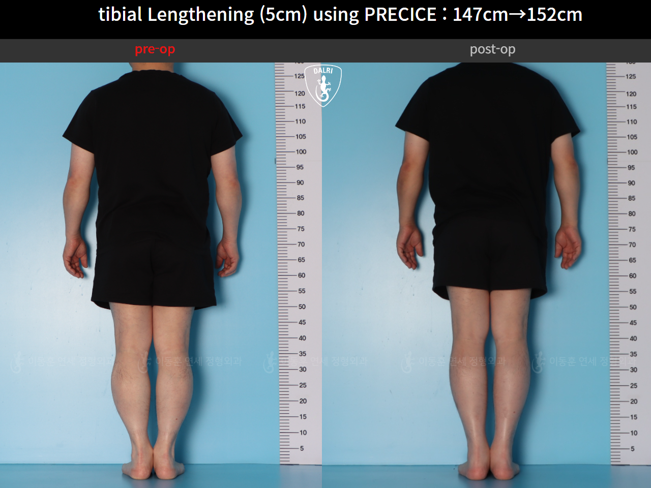 Before and after cll precice, case 89098588, image 2, Dr. Donghoon institute (DALRI)