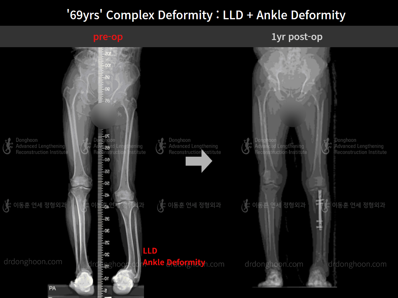 Before and after complex deformity, case 8981701, image 8, Dr. Donghoon institute (DALRI)
