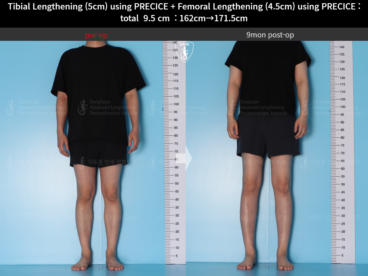 Before and after cll precice, case 15344460, image 2, Dr. Donghoon institute (DALRI)