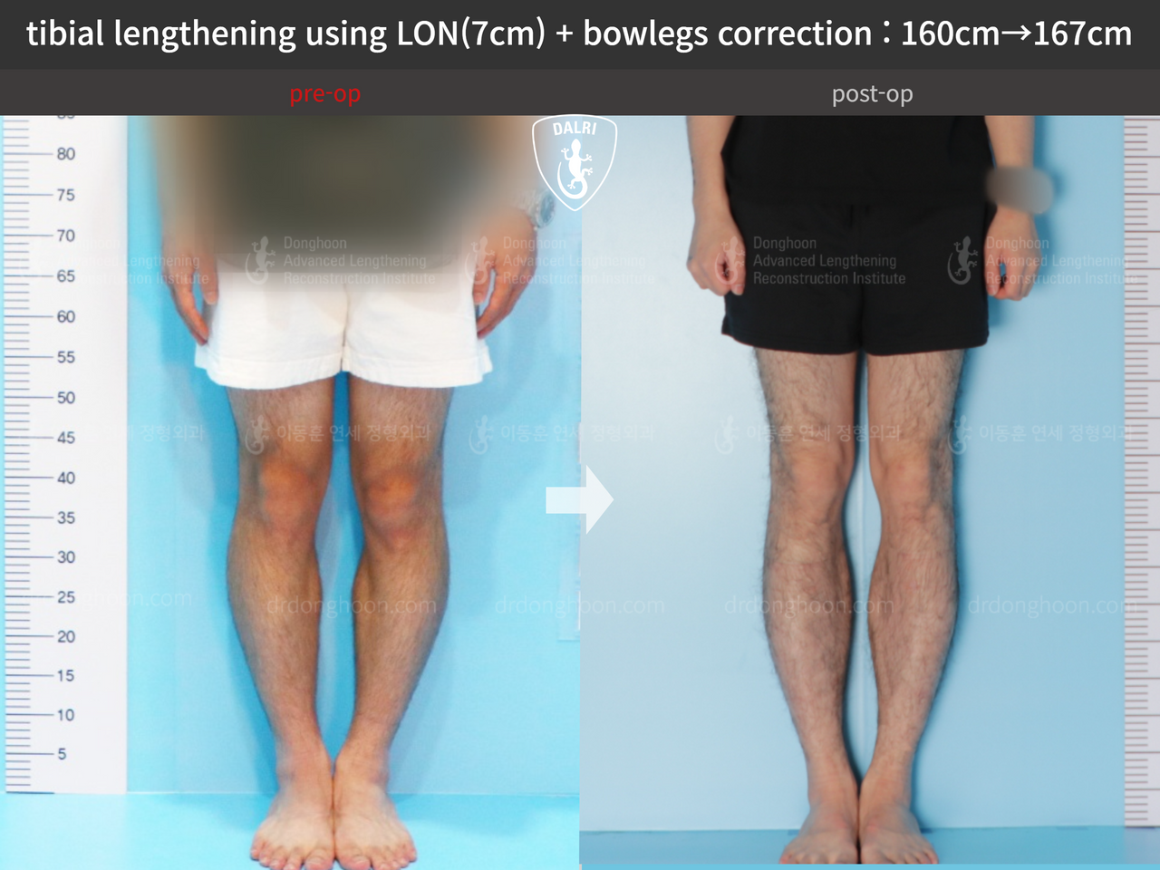 Before and after cll + deformity correction, case 13241722, image 5, Dr. Donghoon institute (DALRI)