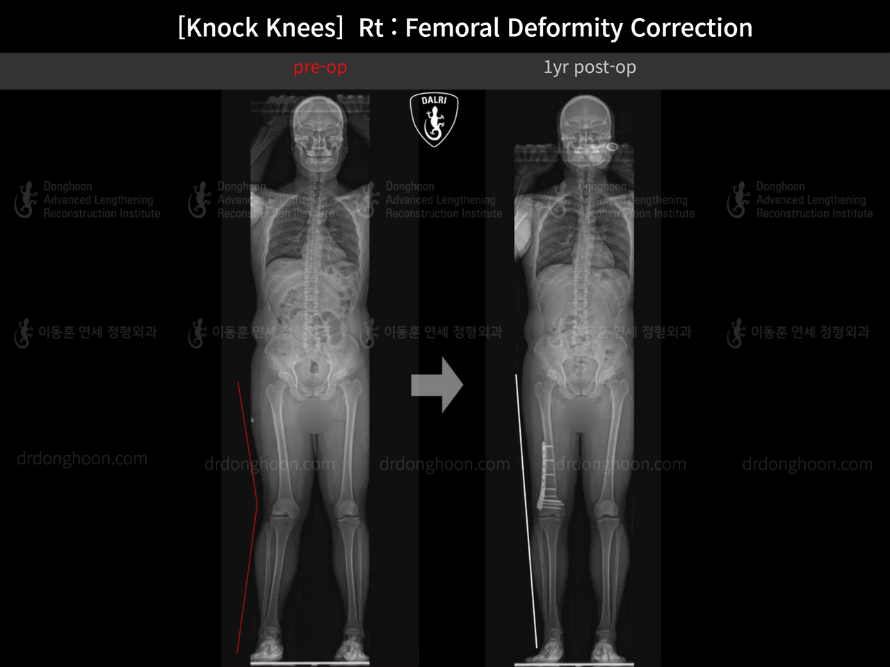 Before and after adult knock knees, case 14009233, image 6, Dr. Donghoon institute (DALRI)