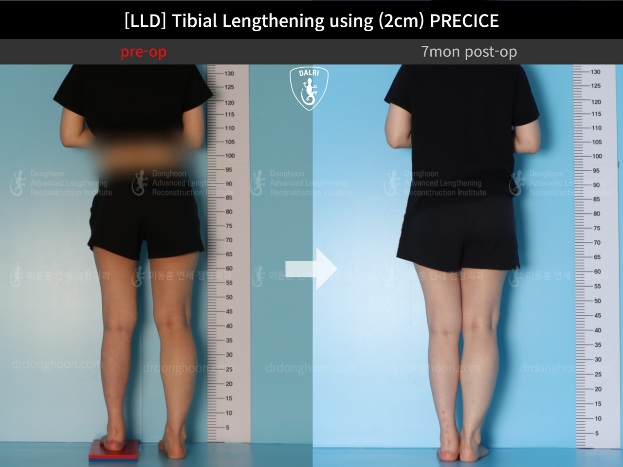 Before and after adult lld, case 12985023, image 2, Dr. Donghoon institute (DALRI)
