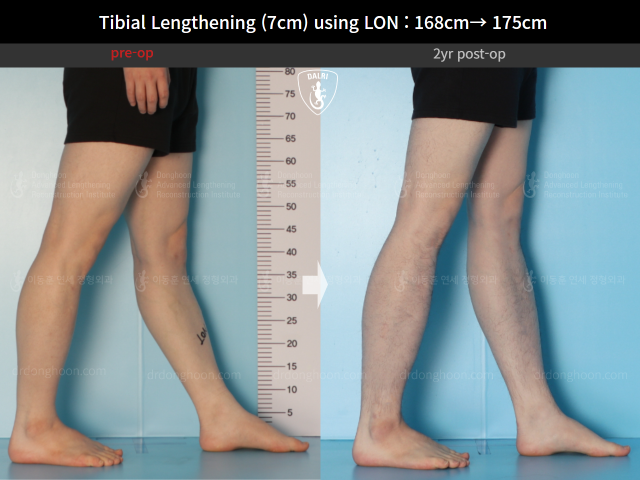 Before and after cll lon, case 14978046, image 12, Dr. Donghoon institute (DALRI)