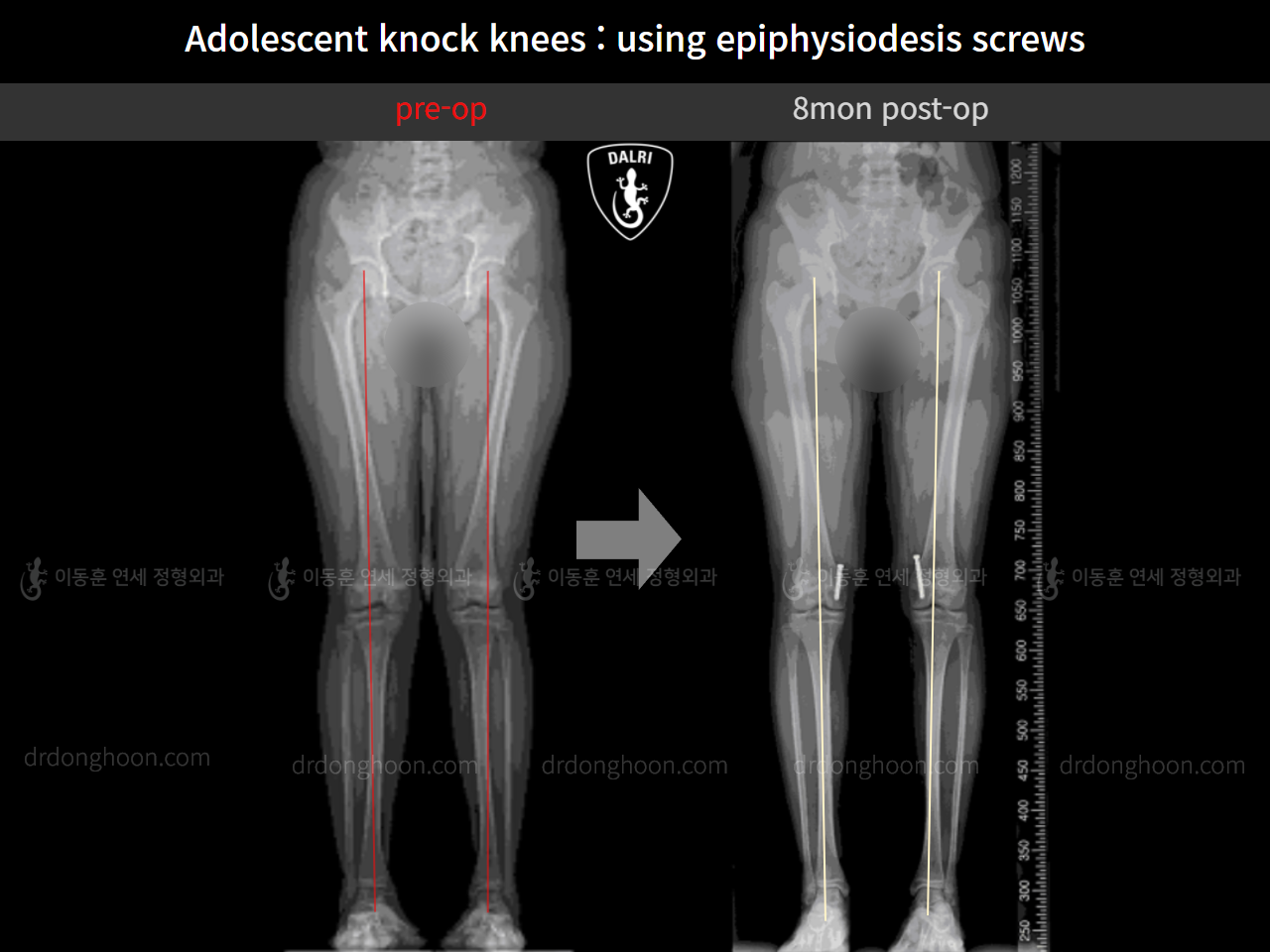 Before and after paediatric & adolescent knock knees, case 10297056, image 7, Dr. Donghoon institute (DALRI)
