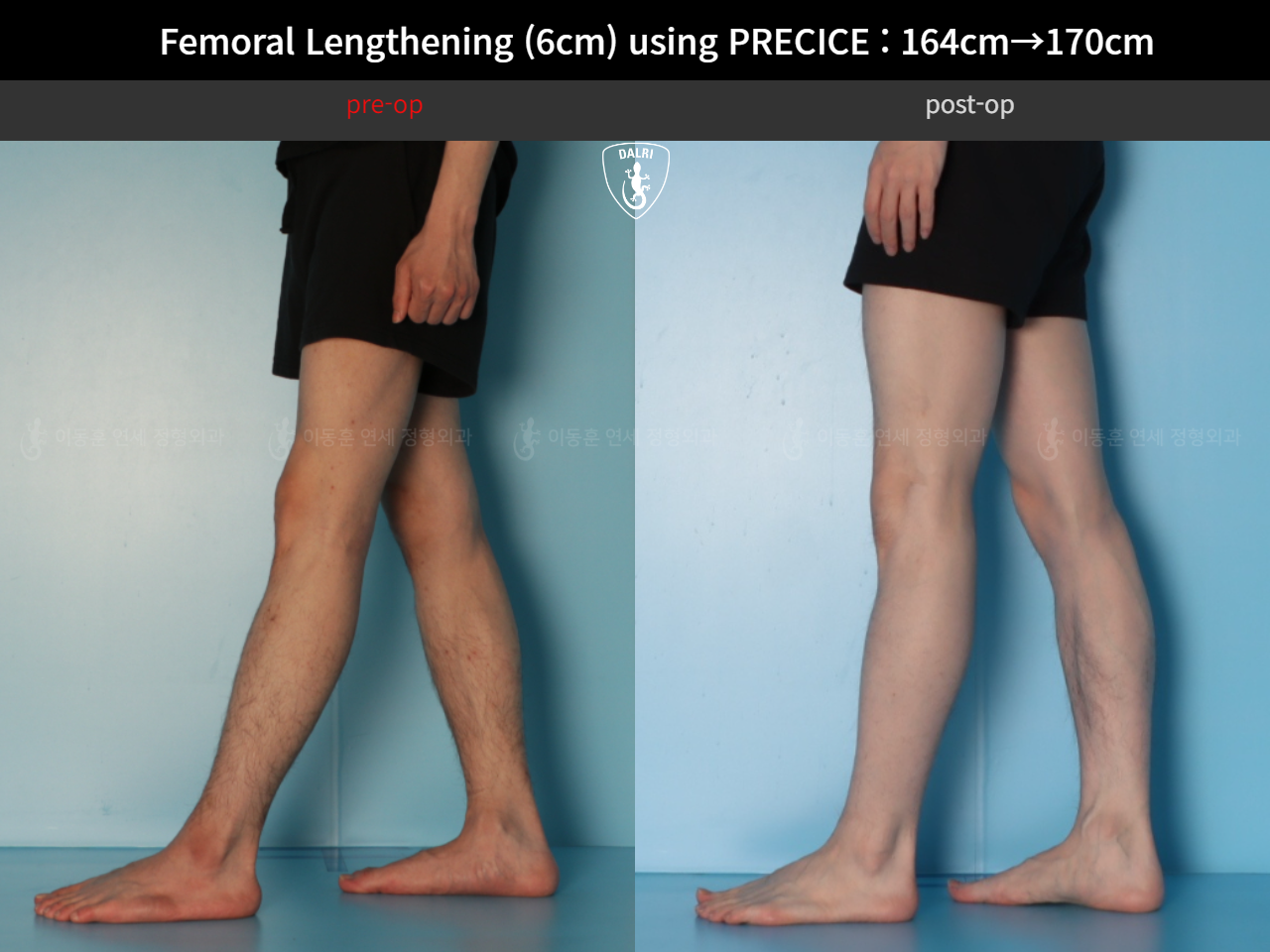 Before and after cll precice, case 33570290, image 10, Dr. Donghoon institute (DALRI)
