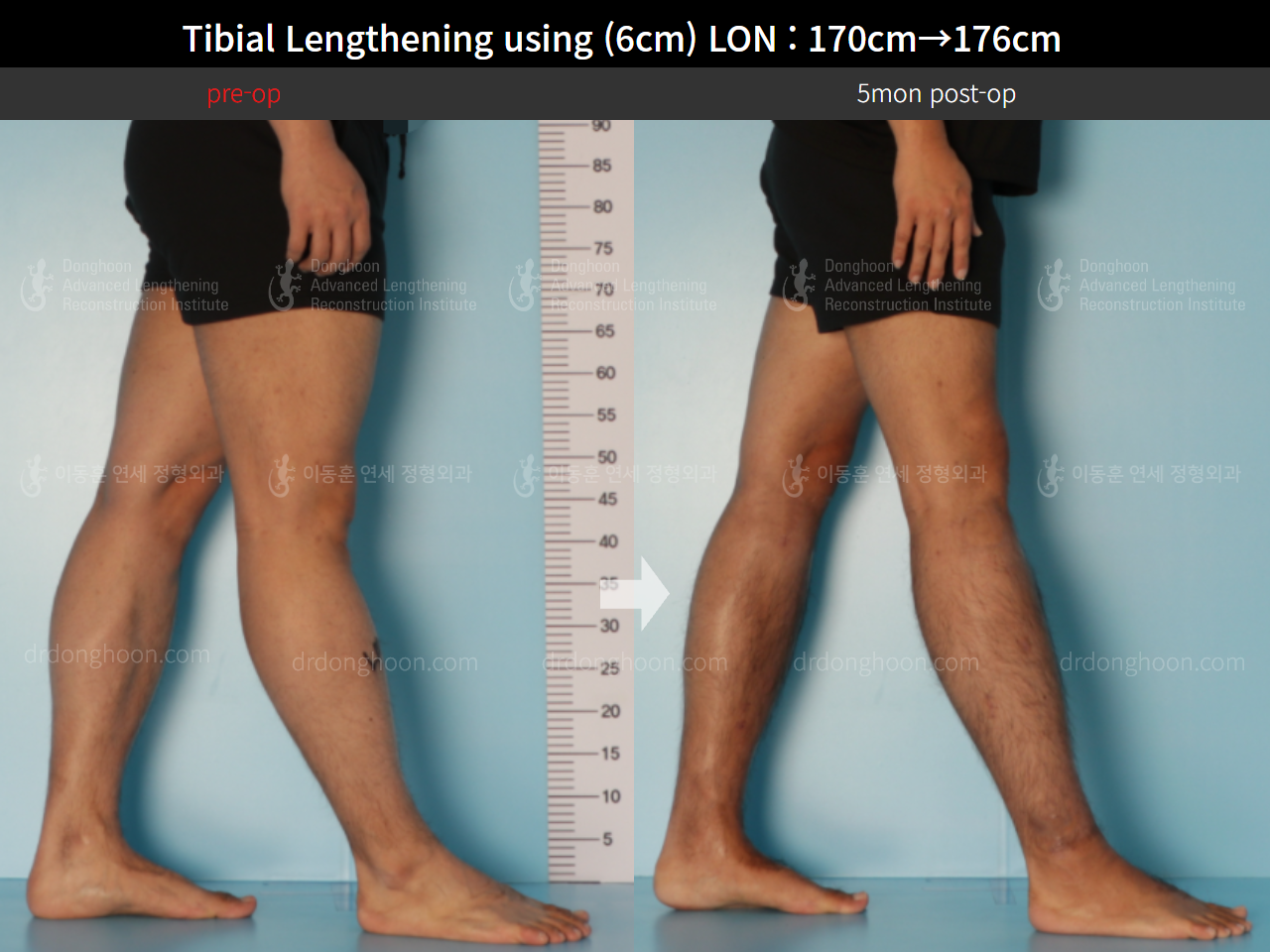 Before and after cll lon, case 8672248, image 8, Dr. Donghoon institute (DALRI)