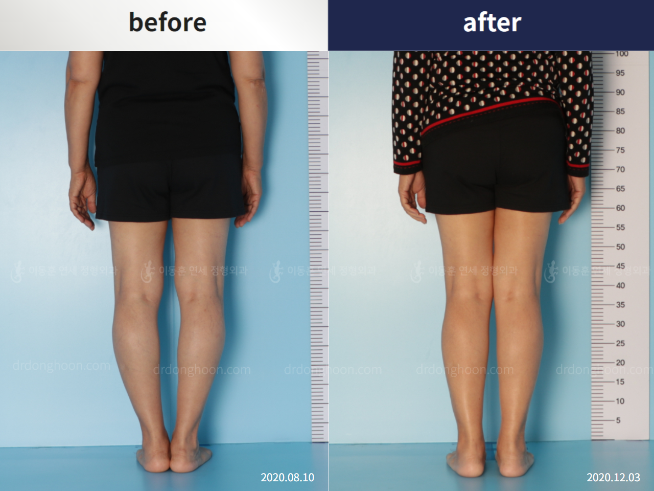 Before and after osteotomy for knee osteoarthritis, case 5455902, image 3, Dr. Donghoon institute (DALRI)