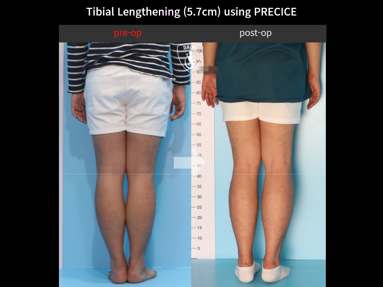 Before and after cll precice, case 4323384, image 4, Dr. Donghoon institute (DALRI)