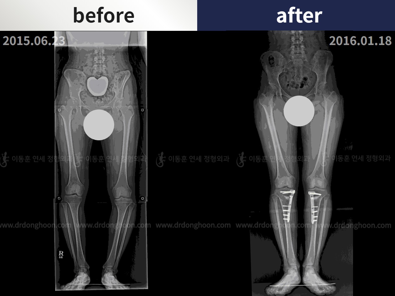 Before and after adult bowlegs, case 4311018, image 3, Dr. Donghoon institute (DALRI)