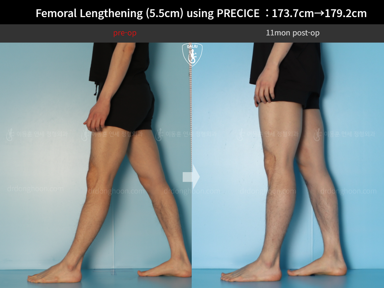 Before and after cll precice, case 18140453, image 11, Dr. Donghoon institute (DALRI)