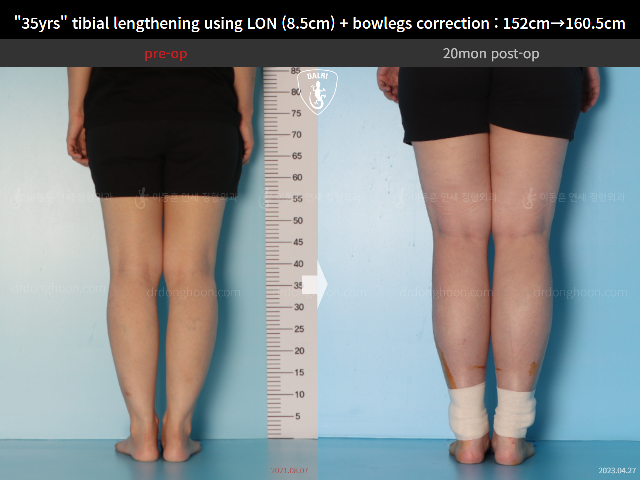 Before and after cll lon, case 15036651, image 8, Dr. Donghoon institute (DALRI)